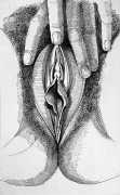 Surgically altered vulva